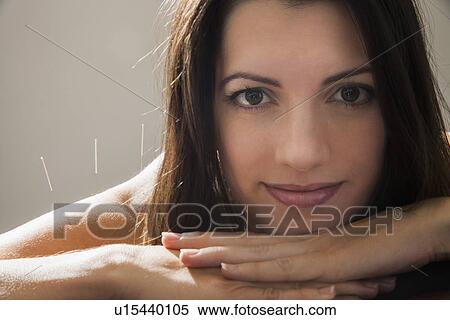 Close up of woman with acupuncture needles in her shoulder View Large Photo Image Stock Photography - Close up of woman with acupuncture needles in her shoulder. Fotosearch