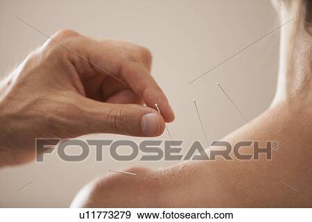 Stock Photo - Doctor's hand putting in acupuncture needle. Fotosearch