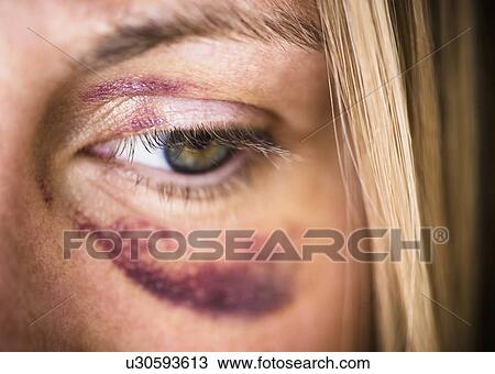 Stock Image - Portrait of woman with black eye. Fotosearch