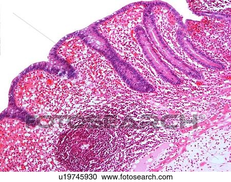Stock Image - Appendicitis, light micrograph. Fotosearch