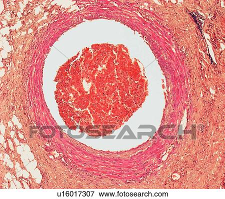 Stock Photo - Blood clot, light micrograph. Fotosearch