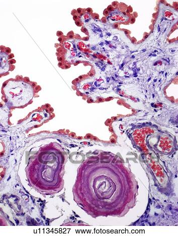 Stock Photo - Corpora amylacea, light micrograph. Fotosearch