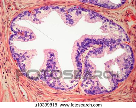 Stock Photo - Graves disease, light micrograph. Fotosearch