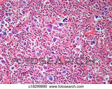 Stock Image - Hodgkin's lymphoma, light micrograph. Fotosearch