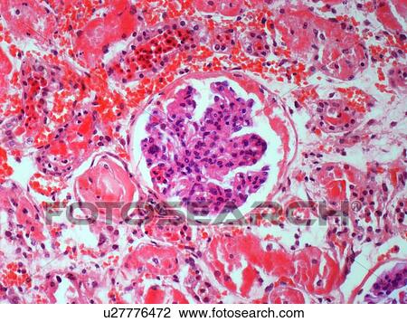 Stock Image - Kidney disease, light micrograph. Fotosearch