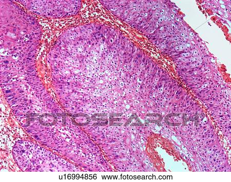 Stock Photograph - Wart, light micrograph. Fotosearch
