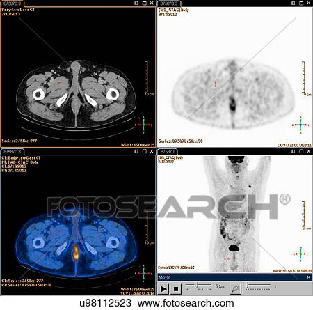 Stock Image - A composite Positron set of Emission Tomography (PET) scan images of a male patient aged 54. A tumour can be seen in the left upper lobe of his lungs. Fotosearch