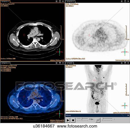 Stock Photo - A composite Positron set of Emission Tomography (PET) scan images of the chest of a male patient aged 54. A tumour can be seen in the left upper lobe of his lungs. Fotosearch