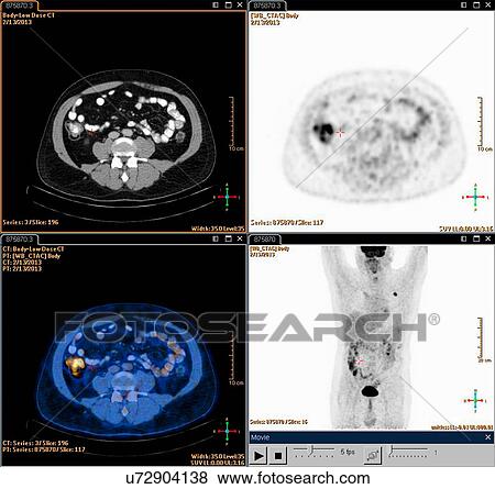 Stock Photo - A composite Positron set of Emission Tomography (PET) scan images of the abdomen of a male patient aged 54. A tumour can be seen in the left upper lobe of his lungs. Fotosearch