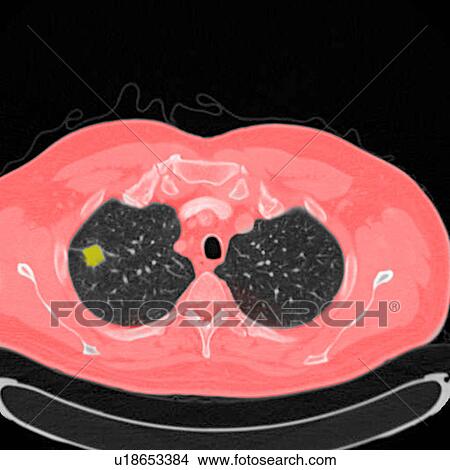 Picture - Chest CT scan (X-ray computed tomography) of a male 54 year old patient. A tumour can be seen in the left upper lobe of his lungs. Fotosearch