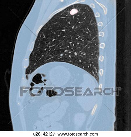Stock Photo - Chest CT scan (X-ray computed tomography) of a male 54 year old patient. A tumour can be seen in the left upper lobe of his lungs. Fotosearch