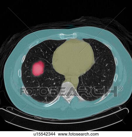 Picture - Positron emission tomography (PET) scan of a male, 54 year old patient. A tumour can be seen in the left upper lobe of his lungs. Fotosearch
