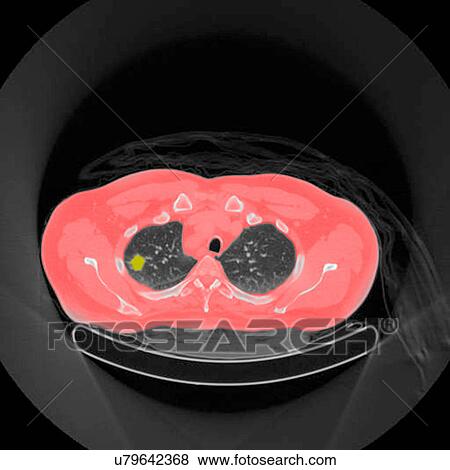 Stock Photo - Positron emission tomography (PET) scan of a male, 54 year old patient. A tumour can be seen in the left upper lobe of his lungs. Fotosearch