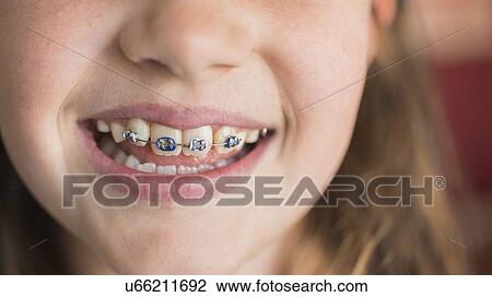 Stock Image - Close up of girl's (8-9) mouth with braces. Fotosearch