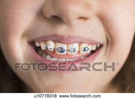 Close up of girl's (8-9) mouth with braces View Large Photo Image Stock Photo - Close up of girl's (8-9) mouth with braces. Fotosearch
