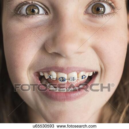 Girl (8-9) showing braces View Large Photo Image Stock Image - Girl (8-9) showing braces. Fotosearch