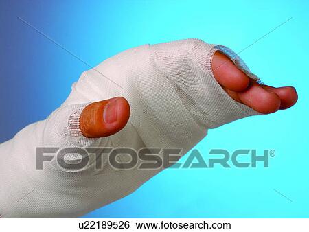Stock Photograph - bind, covered, brace, arm. Fotosearch