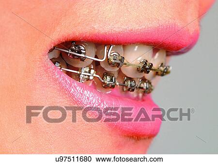 Braces, Chin, Close-Up, Facial Expression View Large Photo Image Stock Image - Braces, Chin, Close-Up, Facial Expression. Fotosearch