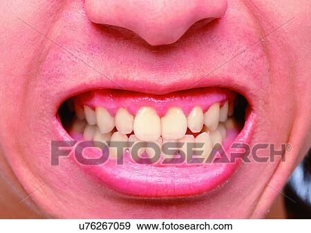 Stock Photo - Braces, Chin, Close-Up, Facial Expression. Fotosearch