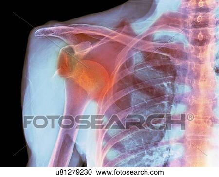 Stock Image - Dislocated shoulder, X-ray. Fotosearch