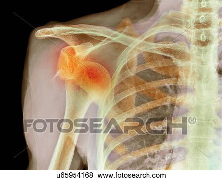 Dislocated shoulder, X-ray View Large Photo Image Stock Photo - Dislocated shoulder, X-ray. Fotosearch