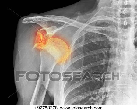 Stock Photo - Dislocated shoulder, X-ray. Fotosearch