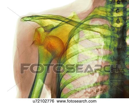Dislocated shoulder, X-ray View Large Photo Image Stock Photograph - Dislocated shoulder, X-ray. Fotosearch