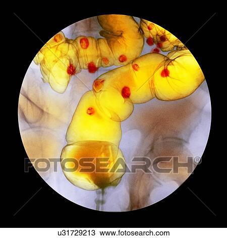 Stock Image - Diverticulitis, X-ray. Fotosearch