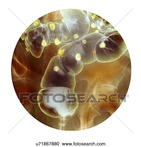 Diverticulitis, X-ray View Large Photo Image Stock Image - Diverticulitis, X-ray. Fotosearch