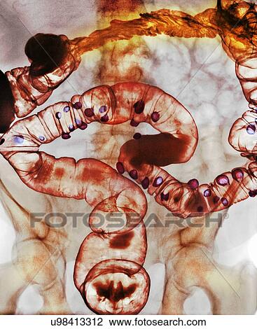Diverticulitis, X-ray View Large Photo Image Stock Image - Diverticulitis, X-ray. Fotosearch