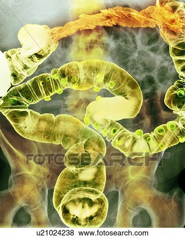 Diverticulitis, X-ray View Large Photo Image Stock Photo - Diverticulitis, X-ray. Fotosearch