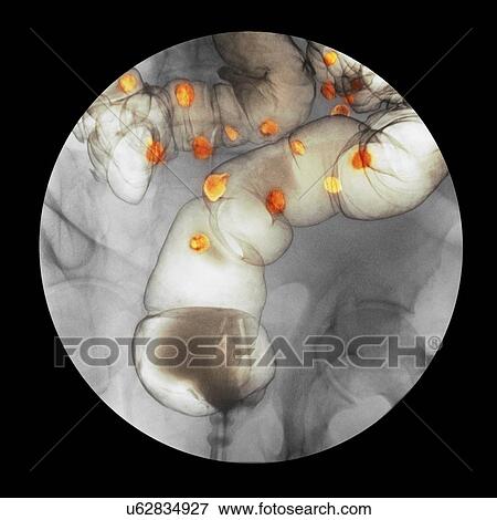 Stock Photo - Diverticulitis, X-ray. Fotosearch