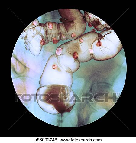 Stock Photo - Diverticulitis, X-ray. Fotosearch