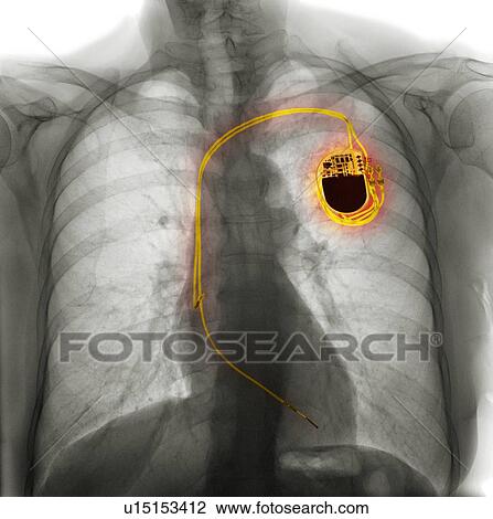 Dual chamber pacemaker, X-ray View Large Photo Image Stock Image - Dual chamber pacemaker, X-ray. Fotosearch