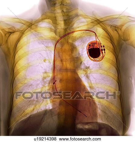 Stock Photo - Dual chamber pacemaker, X-ray. Fotosearch