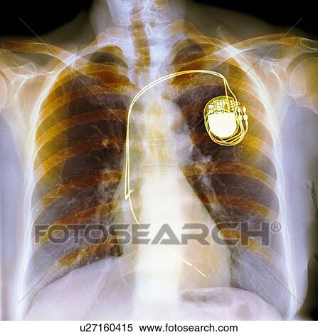 Stock Photography - Dual chamber pacemaker, X-ray. Fotosearch