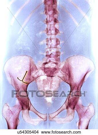 Ectopic IUD contraceptive, X-ray View Large Photo Image Picture - Ectopic IUD contraceptive, X-ray. Fotosearch