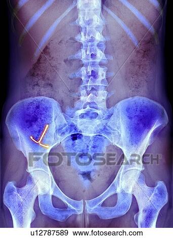 Stock Photo - Ectopic IUD contraceptive, X-ray. Fotosearch