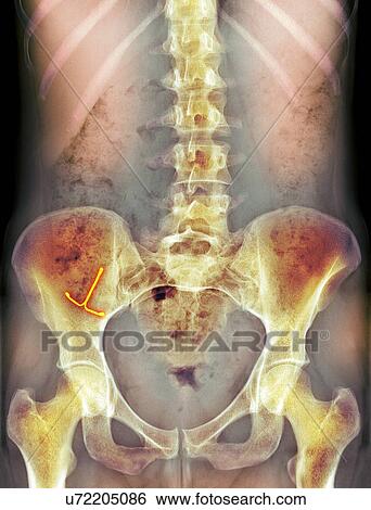 Ectopic IUD contraceptive, X-ray View Large Photo Image Stock Photograph - Ectopic IUD contraceptive, X-ray. Fotosearch