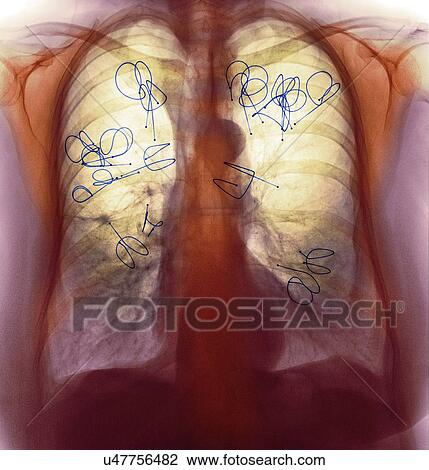 Endobronchial valves, X-ray View Large Photo Image Stock Image - Endobronchial valves, X-ray. Fotosearch