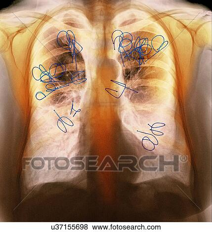 Endobronchial valves, X-ray View Large Photo Image Stock Photo - Endobronchial valves, X-ray. Fotosearch