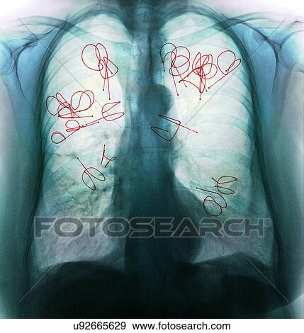 Endobronchial valves, X-ray View Large Photo Image Stock Photo - Endobronchial valves, X-ray. Fotosearch