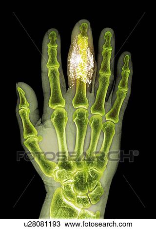 Stock Image - Foreign body in finger, X-ray. Fotosearch