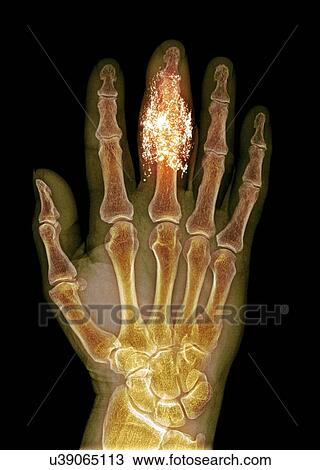 Stock Image - Foreign body in finger, X-ray. Fotosearch