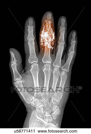 Stock Image - Foreign body in finger, X-ray. Fotosearch