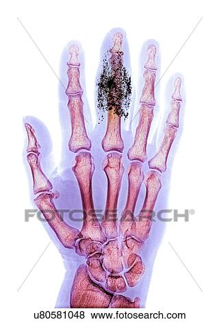 Stock Photo - Foreign body in finger, X-ray. Fotosearch