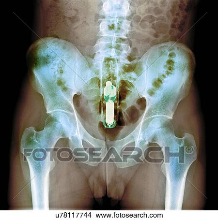Foreign object in rectum, X-ray View Large Photo Image Picture - Foreign object in rectum, X-ray. Fotosearch