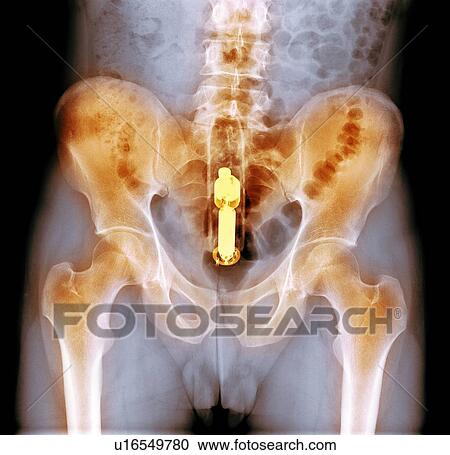 Stock Image - Foreign object in rectum, X-ray. Fotosearch