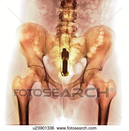 Foreign object in rectum, X-ray View Large Photo Image Stock Photograph - Foreign object in rectum, X-ray. Fotosearch