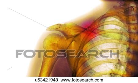 Stock Photo - Fractured collarbone, X-ray. Fotosearch